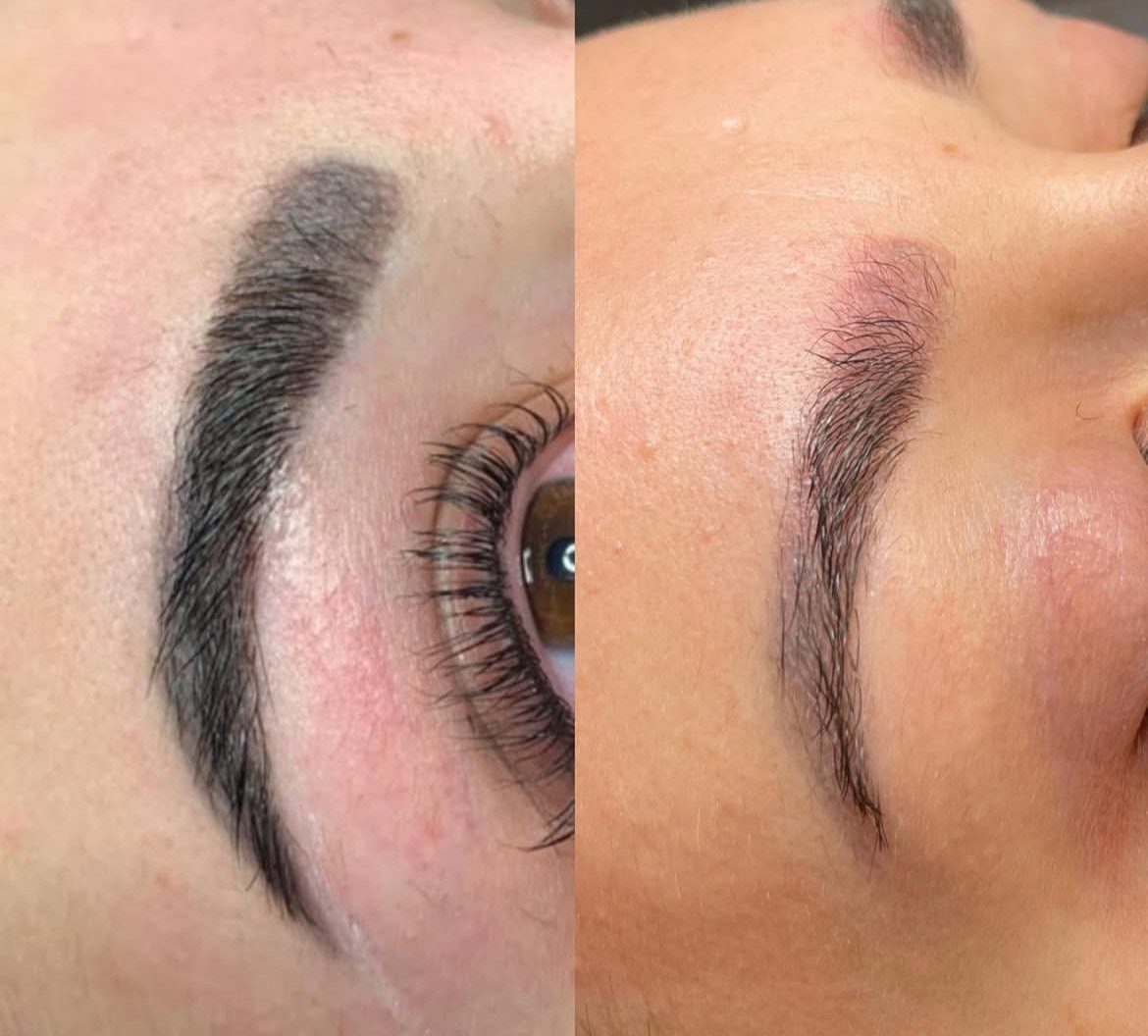 Détatouage sans laser